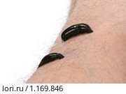 Гирудотерапия. Медицинские пиявки (Hirudo medicinalis) на ноге пациента. Стоковое фото, фотограф Татьяна Белова / Фотобанк Лори