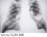 Междолевой плеврит (двояковыпуклая линза) Стоковое фото, фотограф Doc... / Фотобанк Лори