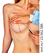 Breast cancer surgery. Doctor makes dotted line female body. Стоковое фото, фотограф Gennadiy Poznyakov / Фотобанк Лори