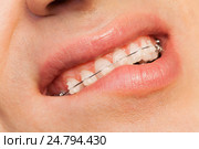 Man showing orthodontics correction of jaws. Стоковое фото, фотограф Сергей Новиков / Фотобанк Лори