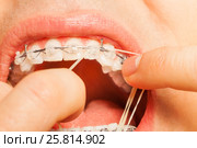 Putting rubber string on braces hooks teeth. Стоковое фото, фотограф Сергей Новиков / Фотобанк Лори