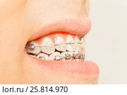 Profile view of braces for orthodontic treatment. Стоковое фото, фотограф Сергей Новиков / Фотобанк Лори
