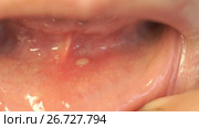 Close-up of stomatitis into mouth. Стоковое видео, видеограф worker / Фотобанк Лори