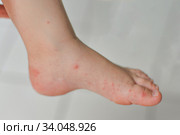 Enterovirus Leg arm mouth Rash on the body of a child Cocksackie virus. Стоковое фото, фотограф Irina Kuchugurina/Gaudy / Фотобанк Лори