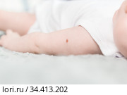 След на руке младенца от прививки БЦЖ - вакцины против туберкулёза. Стоковое фото, фотограф Наталья Гармашева / Фотобанк Лори