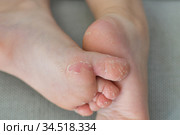 Enterovirus foot hand mouth Skin peeled off on the body of a child Cocksackie virus. Стоковое фото, фотограф Irina Kuchugurina/Gaudy / Фотобанк Лори