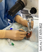 Ophthalmologist performs a complex operation to restore the cornea of eye. Doctor looks through microscope and works with a scalpel. Стоковое фото, фотограф Евгений Ткачёв / Фотобанк Лори