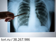 X-ray of the lungs. Chest x-ray. Doctor's view of the lung image in the hospital on a reflective board, blurred focus. Стоковое фото, фотограф Светлана Акифьева / Фотобанк Лори