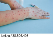Monkey pox virus, a new world problem of modern humanity. Close-up of the hands of a sick person with pimples and blisters. Стоковое фото, фотограф Ирина Старикова / Фотобанк Лори