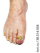 Fungal Nail Infection. Стоковое фото, фотограф Lekcej / Фотобанк Лори