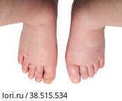 Swollen legs with fungi. Стоковое фото, фотограф Lekcej / Фотобанк Лори