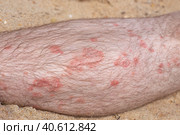 Part of a male leg with psoriatic plaques, covered with hair. Skin diseases in adults. Стоковое фото, фотограф Коханова Наталья / Фотобанк Лори