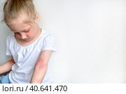 Ребенок чешет атопичную кожу. Дерматит, диатез, аллергия на теле ребенка. Стоковое фото, фотограф Терехова Марина / Фотобанк Лори