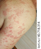 Urticaria blisters on the skin. Severe allergic skin reaction. Close-up. Стоковое фото, фотограф Оксана Медведева / Фотобанк Лори
