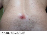 Abscess furuncle carbuncle on male hairy back. Clogged pore leading to skin inflammation. Surgical solution of cosmetic problems. Redness, swelling and pimple formation. Dermatology and surgery. Стоковое фото, фотограф Юлия Петровская / Фотобанк Лори