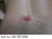 Abscess furuncle carbuncle on male hairy back. Clogged pore leading to skin inflammation. Surgical solution of cosmetic problems. Redness, swelling and pimple formation. Dermatology and surgery. Стоковое фото, фотограф Юлия Петровская / Фотобанк Лори