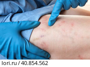 Phlebologist examines a patient with varicose veins on his leg. Leg pain. Phlebology. Venous pathologies of the lower extremities. Human vessel, arteries. Capillaries. Blood system. Health legs. Стоковое фото, фотограф Марина Демидюк / Фотобанк Лори