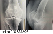 Plain X ray of the knee shows apparent joint osteoarthritis according to Kellgren and Lawrence system, subchondral sclerosis, knee joint inflammation. Стоковое видео, видеограф Ирина Старикова / Фотобанк Лори