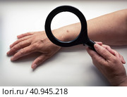 Пожилая женщина рассматривает свою большую выпуклую родинку на руке с помощью лупы. Контроль за изменением состояния родимого пятна, воздействием солнечного света на кожу, предотвращения ракового заболевания. Стоковое фото, фотограф Светлана Ельцова / Фотобанк Лори
