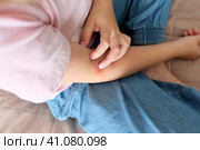 The child applies a special cream to atopic skin. Dermatitis, diathesis, allergy on the child's body. Стоковое фото, фотограф Терехова Марина / Фотобанк Лори