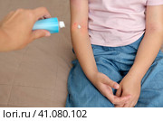 The child applies a special cream to atopic skin. Dermatitis, diathesis, allergy on the child's body. Стоковое фото, фотограф Терехова Марина / Фотобанк Лори