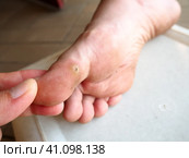 Plantar warts Verruca plantaris are warts caused by human papillomaviruses HPV appear on the soles or toes. The defeat of the sole of the foot, hard and rough papules, destroying papillary patterns. Стоковое фото, фотограф Юлия Петровская / Фотобанк Лори