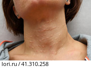 Caucasian brunette woman neck skin after biorevitalization procedure. Multiple injection marks are visible on the skin. Grey background. Кожа шеи белокурой брюнетки после процедуры биоревитализации. На коже видны множественные следы от инъекций. Серый фон. Стоковое фото, фотограф Дмитрий Березнев / Фотобанк Лори