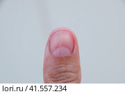 Forked nail on the thumb. Dilation of the nail, traumatic pathology. The nail is divided in half. Стоковое фото, фотограф Леонид Еремейчук / Фотобанк Лори