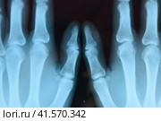 X ray of the hands, a picture of the bones of the hands on the x-ray. Стоковое фото, фотограф Леонид Еремейчук / Фотобанк Лори