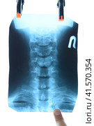 X-ray of the cervical vertebrae. X ray image of the cervical spine. Стоковое фото, фотограф Леонид Еремейчук / Фотобанк Лори