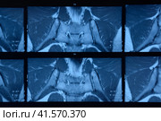MRI sacroiliac articulation. Study of ankylosing spondyloarthritis patient. Стоковое фото, фотограф Леонид Еремейчук / Фотобанк Лори