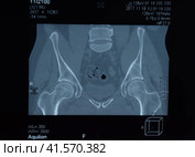 MRI sacroiliac articulation. Study of ankylosing spondyloarthritis patient. Стоковое фото, фотограф Леонид Еремейчук / Фотобанк Лори