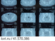 MRI sacroiliac articulation. Study of ankylosing spondyloarthritis patient. Стоковое фото, фотограф Леонид Еремейчук / Фотобанк Лори