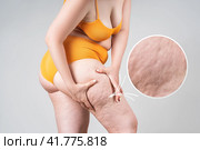 Obesity female legs with cellulite, fat thighs and buttocks with an enlarged area of skin. Стоковое фото, фотограф Станислав Тарко / Фотобанк Лори