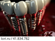 Dental implant and ceramic crown. Medically accurate tooth 3D illustration. Стоковое AI-изображение, AI-художник Ирина Михайличенко / Фотобанк Лори