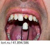 patient without a tooth is trying on a denture. Стоковое фото, фотограф Леонид Еремейчук / Фотобанк Лори
