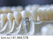 Dental Implants: Modern Solutions for a Healthy Smile. Стоковое AI-изображение, AI-художник Юрий Поздников / Фотобанк Лори
