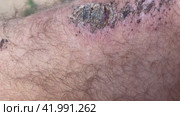 Emergency accident open abrasion wound trauma skin leg knee. People, healthcare and medicine concept. Стоковое видео, видеограф Ирина Старикова / Фотобанк Лори