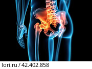Hip joint pain, lumbar spine hernia, human body with osteoarthritis on a black background, health problems concept, AI Generated. Стоковое AI-изображение, AI-художник Станислав Тарко / Фотобанк Лори