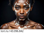 Leukoderma. Vitiligo. Violation of skin pigmentation. Large white spots all over the body and face. Portrait of a beautiful girl with a skin disease. Стоковое AI-изображение, AI-художник Photojuli / Фотобанк Лори