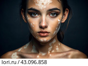 Leukoderma. Vitiligo. Violation of skin pigmentation. Large white spots all over the body and face. Portrait of a beautiful girl with a skin disease. Стоковое AI-изображение, AI-художник Photojuli / Фотобанк Лори