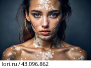 Leukoderma. Vitiligo. Violation of skin pigmentation. Large white spots all over the body and face. Portrait of a beautiful girl with a skin disease. Стоковое AI-изображение, AI-художник Photojuli / Фотобанк Лори