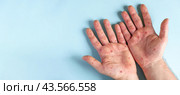 Male hands with Monkeypox rash. Patient with MonkeyPox viral disease. Close Up of Painful rash, red spots blisters on the skin. Human palm with Health problem. Banner, copy space. Allergy, dermatitis. Стоковое фото, фотограф Марина Демидюк / Фотобанк Лори