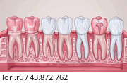 Tooth decay stages showing enamel dentin pulp and bone loss. Стоковое AI-изображение, AI-художник Юрий Поздников / Фотобанк Лори