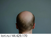 Unadorned Baldness head problem. Generate ai. Стоковое AI-изображение, AI-художник Иван Рябоконь / Фотобанк Лори