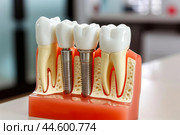 Dental implant model on display. Стоковое AI-изображение, AI-художник Иван Рябоконь / Фотобанк Лори