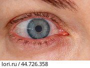 Red inflamed eye with contact lens, close-up macrophoto. Dilation of blood vessels of eye, strain from computer. Treating dry and sore eyes. Lenses cause eye inflammation. Стоковое фото, фотограф Павел Муравьев / Фотобанк Лори