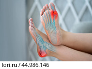 Joint diseases, hallux valgus, plantar fasciitis, heel spur, woman's leg hurts, pain in the foot, female feet closeup. Стоковое фото, фотограф Станислав Тарко / Фотобанк Лори