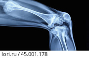 X-ray image of human knee showing bones and ligaments. Стоковое AI-изображение, AI-художник Юрий Поздников / Фотобанк Лори