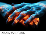 Joints inflammation, rheumatoid arthritis, age-related degenerative changes in the hands. Стоковое AI-изображение, AI-художник Станислав Тарко / Фотобанк Лори